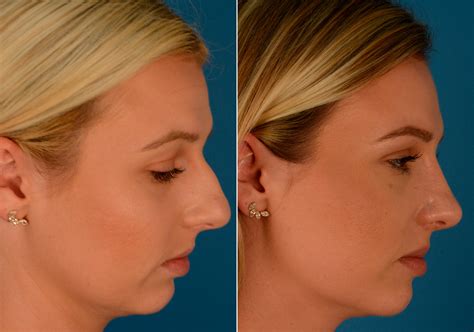 Rhinoplasty .